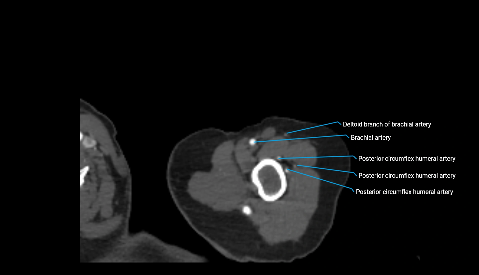 CTA upper limb axial cross sectional anatomy labelled image 310 (1).webp